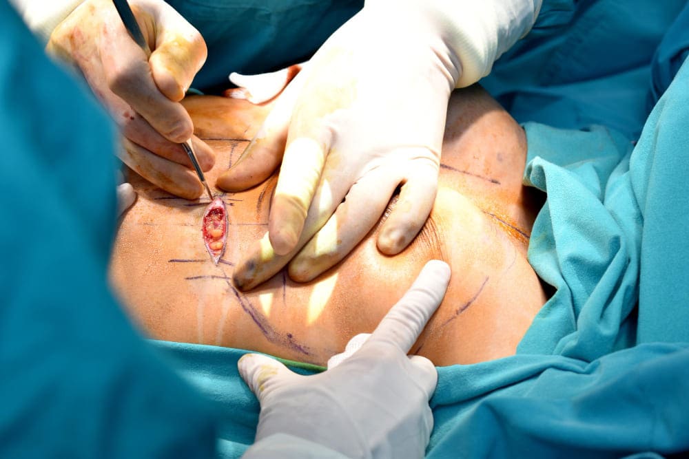 Resolución definitiva de quiste pilonidal en CDMX y Estado de México: Tratamiento quirúrgico especializado