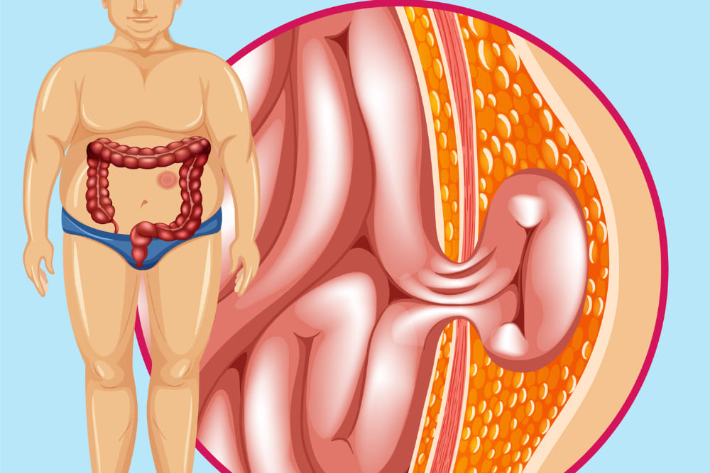 Reparacion de hernias